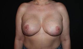 Aesthetic Breast Revision Before & After Gallery - Patient 190612 - Image 2