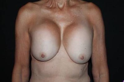 Aesthetic Breast Revision Before & After Gallery - Patient 329086 - Image 1