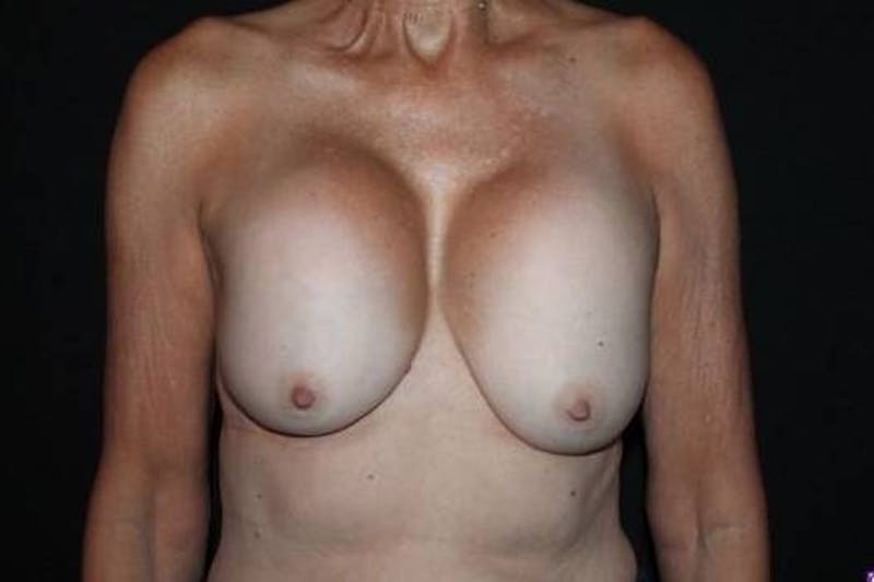 Aesthetic Breast Revision Before & After Gallery - Patient 329086 - Image 1