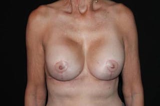 Aesthetic Breast Revision Before & After Gallery - Patient 329086 - Image 2