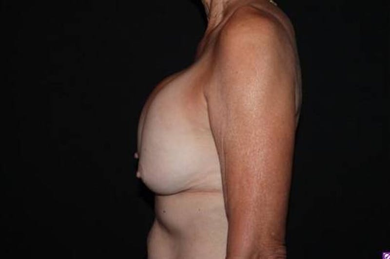 Aesthetic Breast Revision Before & After Gallery - Patient 329086 - Image 5