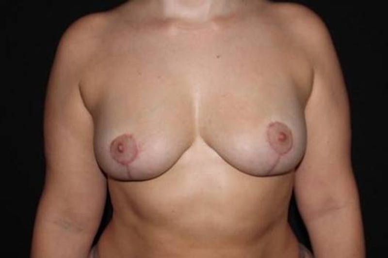 Aesthetic Breast Revision Before & After Gallery - Patient 423162 - Image 2