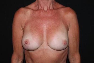 Aesthetic Breast Revision Before & After Gallery - Patient 981061 - Image 2