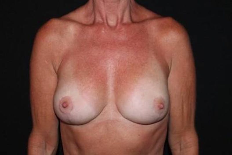 Aesthetic Breast Revision Before & After Gallery - Patient 981061 - Image 2