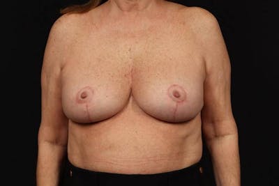 Aesthetic Breast Revision Before & After Gallery - Patient 323447 - Image 2