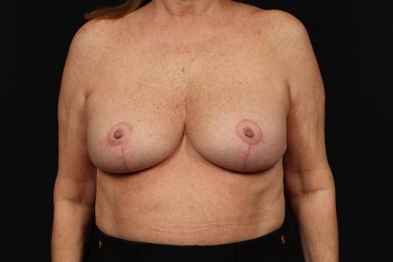 Aesthetic Breast Revision Before & After Gallery - Patient 323447 - Image 2