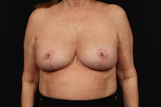 Aesthetic Breast Revision Before & After Gallery - Patient 323447 - Image 2
