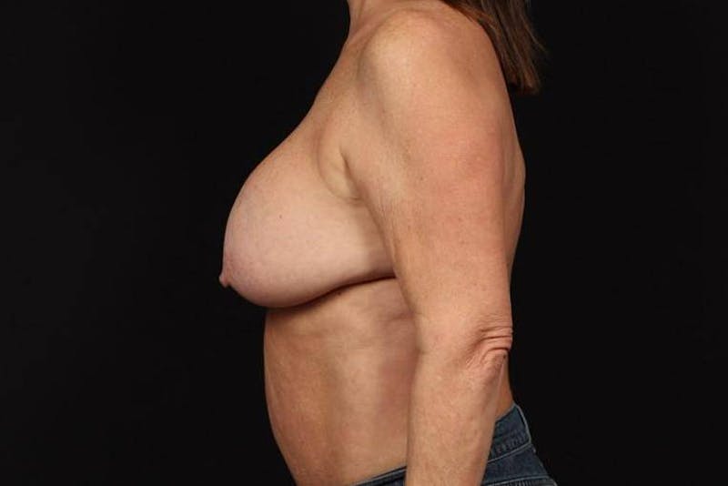 Aesthetic Breast Revision Before & After Gallery - Patient 323447 - Image 5