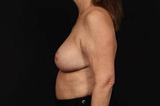Aesthetic Breast Revision Before & After Gallery - Patient 323447 - Image 6