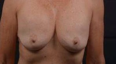 Aesthetic Breast Revision Before & After Gallery - Patient 103776 - Image 1