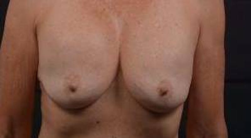 Aesthetic Breast Revision Before & After Gallery - Patient 103776 - Image 1