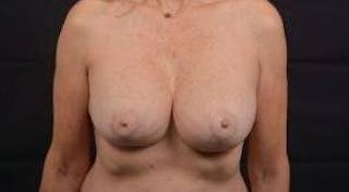 Aesthetic Breast Revision Before & After Gallery - Patient 103776 - Image 2