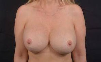 Aesthetic Breast Revision Before & After Gallery - Patient 366678 - Image 2