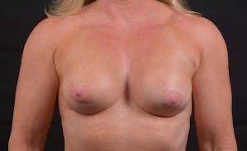 Aesthetic Breast Revision Before & After Gallery - Patient 393082 - Image 1