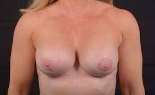 Aesthetic Breast Revision Before & After Gallery - Patient 393082 - Image 2