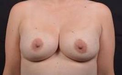 Aesthetic Breast Revision Before & After Gallery - Patient 385454 - Image 1