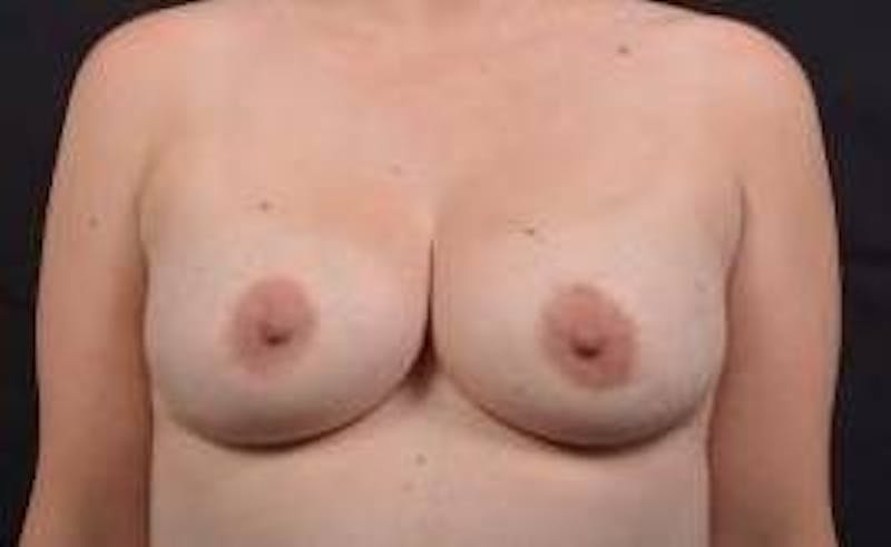 Aesthetic Breast Revision Before & After Gallery - Patient 385454 - Image 1