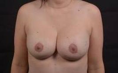 Aesthetic Breast Revision Before & After Gallery - Patient 385454 - Image 2