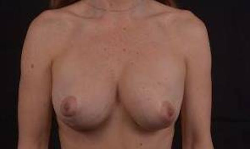 Aesthetic Breast Revision Before & After Gallery - Patient 336700 - Image 1