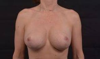Aesthetic Breast Revision Before & After Gallery - Patient 336700 - Image 2