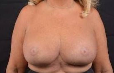 Aesthetic Breast Revision Before & After Gallery - Patient 198859 - Image 2