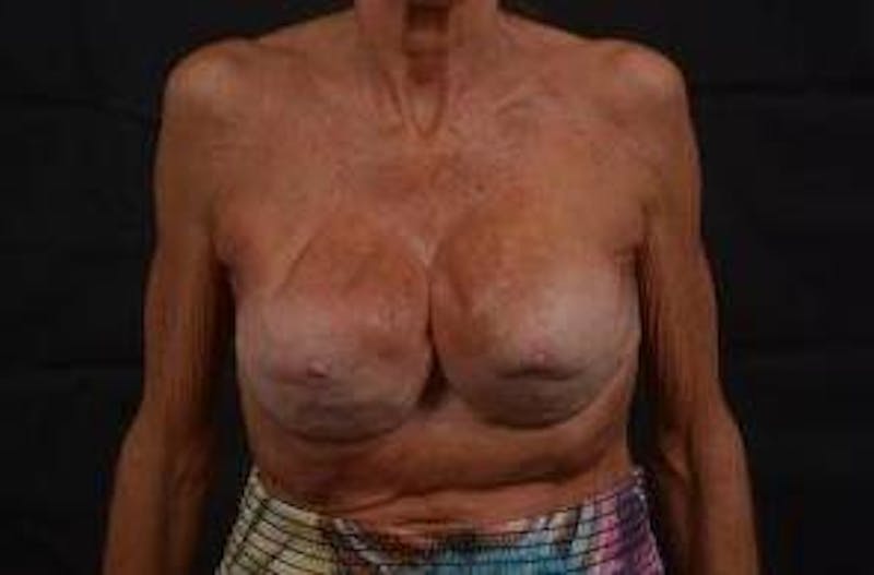 Aesthetic Breast Revision Before & After Gallery - Patient 903974 - Image 1