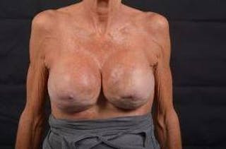 Aesthetic Breast Revision Before & After Gallery - Patient 903974 - Image 2