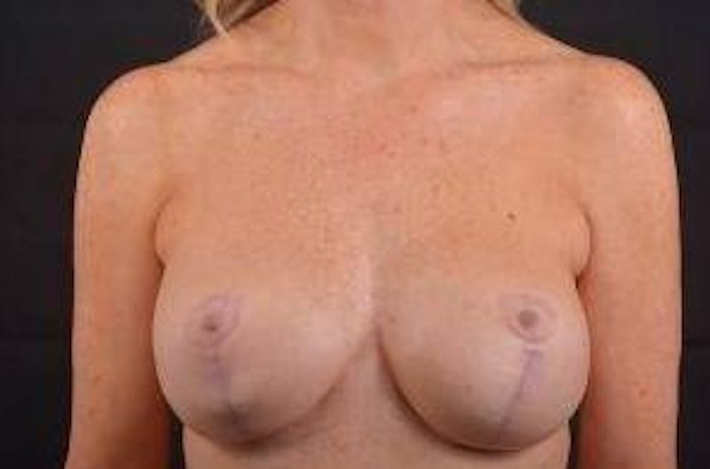 Aesthetic Breast Revision Before & After Gallery - Patient 381841 - Image 1