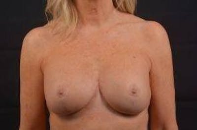 Aesthetic Breast Revision Before & After Gallery - Patient 381841 - Image 2