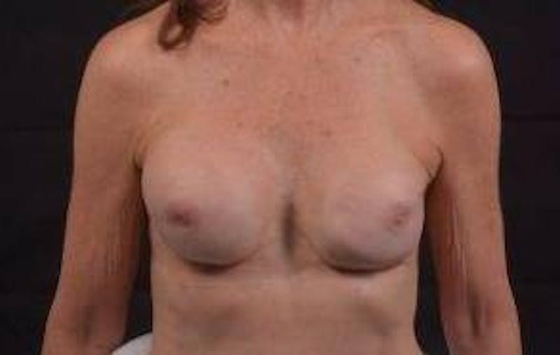 Aesthetic Breast Revision Before & After Gallery - Patient 360015 - Image 1