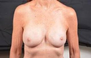 Aesthetic Breast Revision Before & After Gallery - Patient 360015 - Image 2