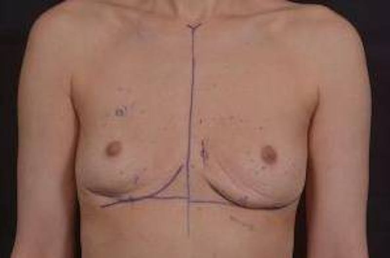 Aesthetic Breast Revision Before & After Gallery - Patient 136019 - Image 1