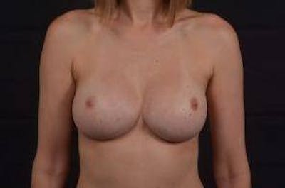 Aesthetic Breast Revision Before & After Gallery - Patient 136019 - Image 2