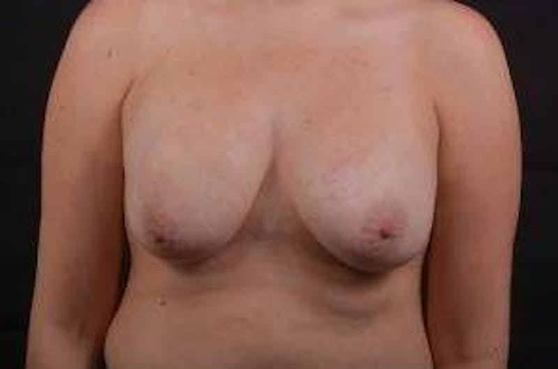 Aesthetic Breast Revision Before & After Gallery - Patient 162451 - Image 1