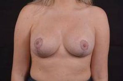 Aesthetic Breast Revision Before & After Gallery - Patient 162451 - Image 2
