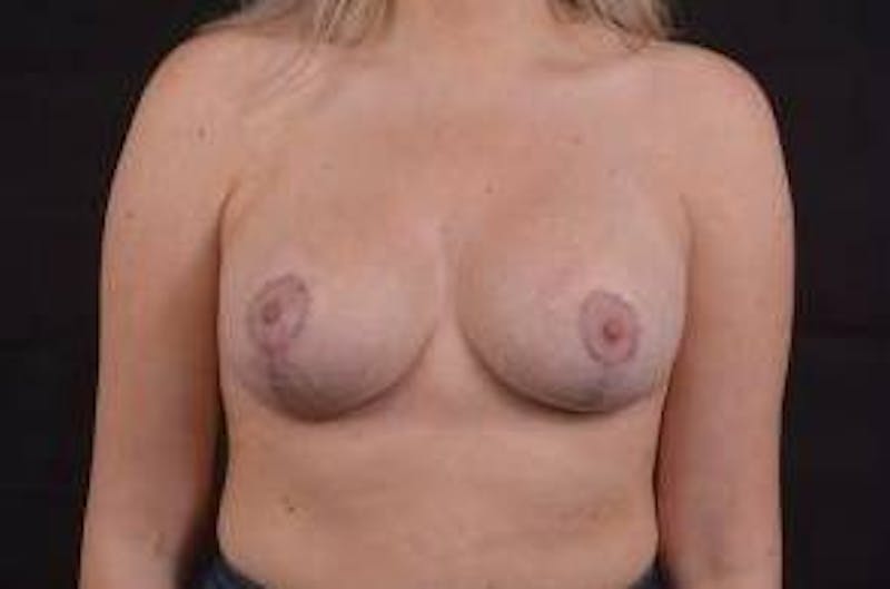 Aesthetic Breast Revision Before & After Gallery - Patient 162451 - Image 2