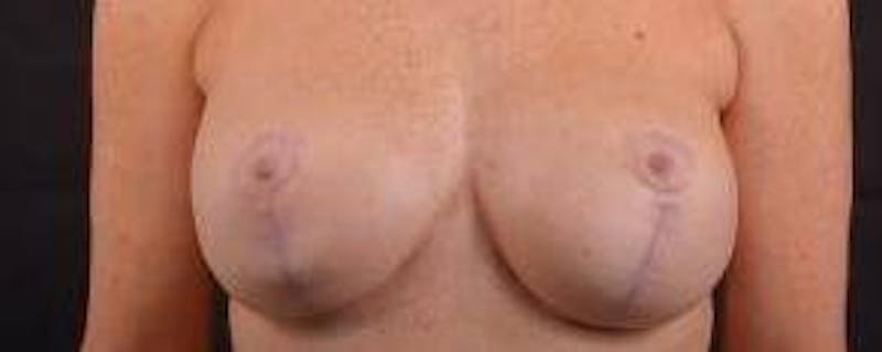 Aesthetic Breast Revision Before & After Gallery - Patient 101391 - Image 1