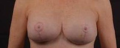 Aesthetic Breast Revision Before & After Gallery - Patient 101391 - Image 2