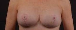 Aesthetic Breast Revision Before & After Gallery - Patient 101391 - Image 2