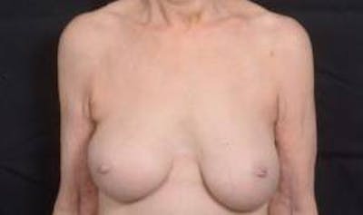 Aesthetic Breast Revision Before & After Gallery - Patient 281728 - Image 1