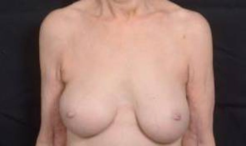 Aesthetic Breast Revision Before & After Gallery - Patient 281728 - Image 1
