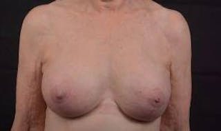 Aesthetic Breast Revision Before & After Gallery - Patient 281728 - Image 2
