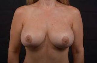 Aesthetic Breast Revision Before & After Gallery - Patient 286019 - Image 2