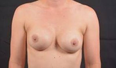 Aesthetic Breast Revision Before & After Gallery - Patient 135077 - Image 1
