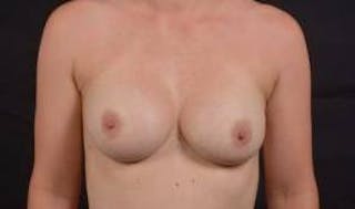 Aesthetic Breast Revision Before & After Gallery - Patient 135077 - Image 2