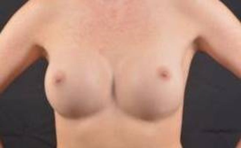 Aesthetic Breast Revision Before & After Gallery - Patient 328152 - Image 1