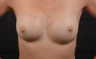 Aesthetic Breast Revision Before & After Gallery - Patient 328152 - Image 2