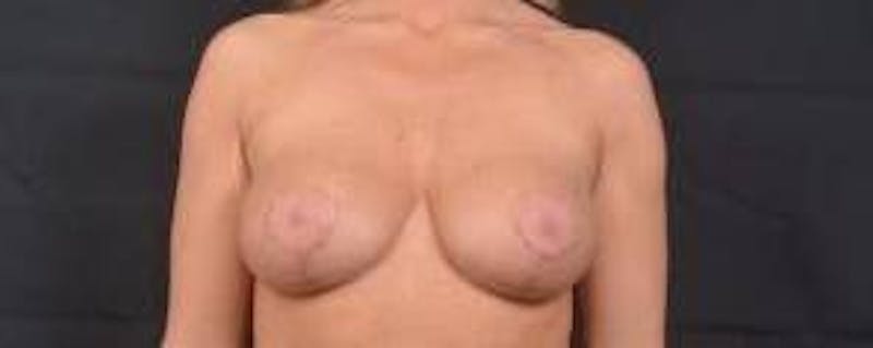 Aesthetic Breast Revision Before & After Gallery - Patient 178104 - Image 1