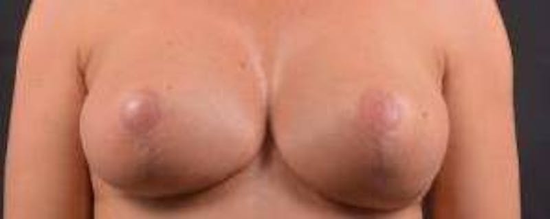 Aesthetic Breast Revision Before & After Gallery - Patient 178104 - Image 2