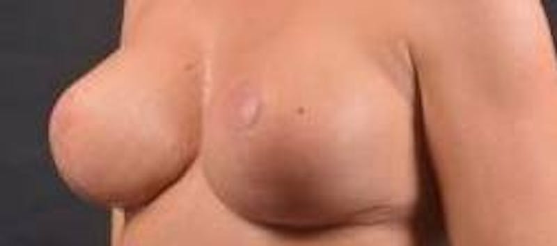 Aesthetic Breast Revision Before & After Gallery - Patient 178104 - Image 8